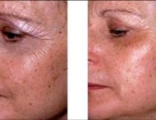 Pelling Facial